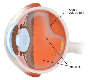 Vitreous Separation - Retina Vitreous Consultants, Inc