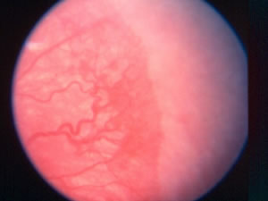 retinopathy of prematurity stage 3