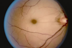 Retinal Artery Occlusion
